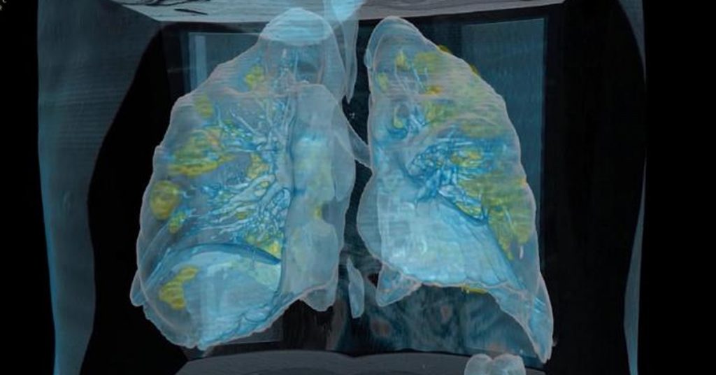 VIDEO: ასე გამოიყურება კორონავირუსით ინფიცირებული პაციენტის ფილტვები 3D-ში