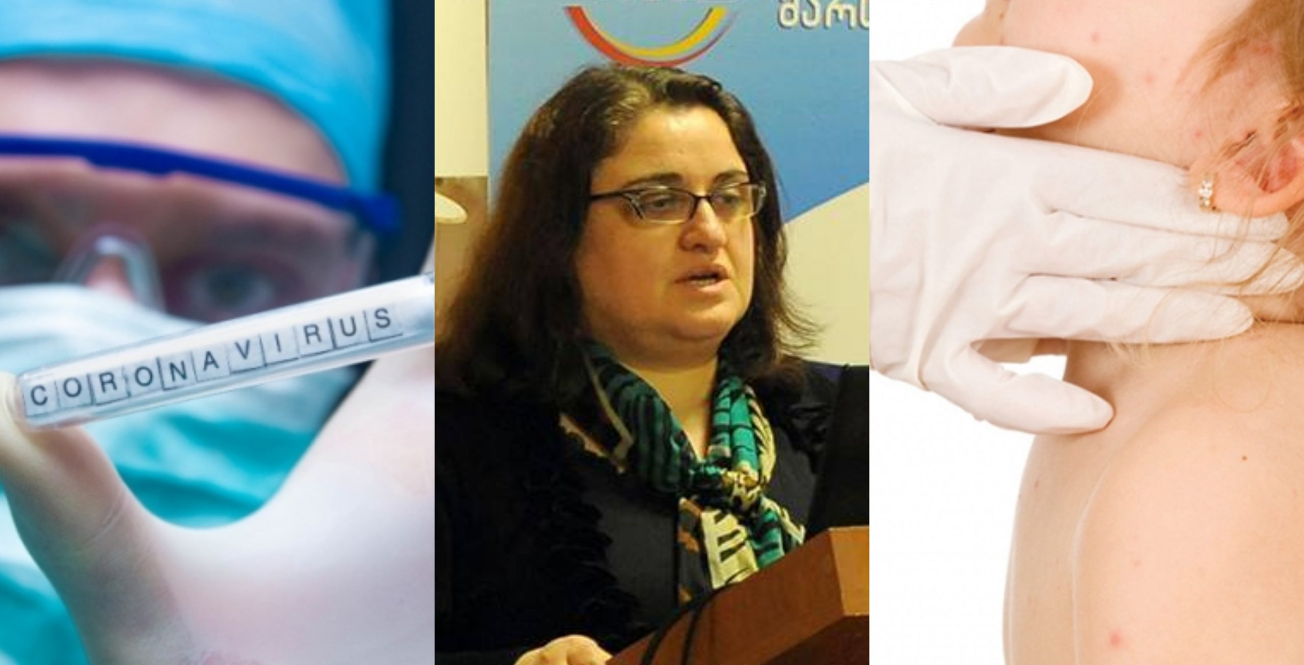 რა არის კავასაკის სინდრომი, რომელიც მშობლებში შიშს და პანიკას იწვევს