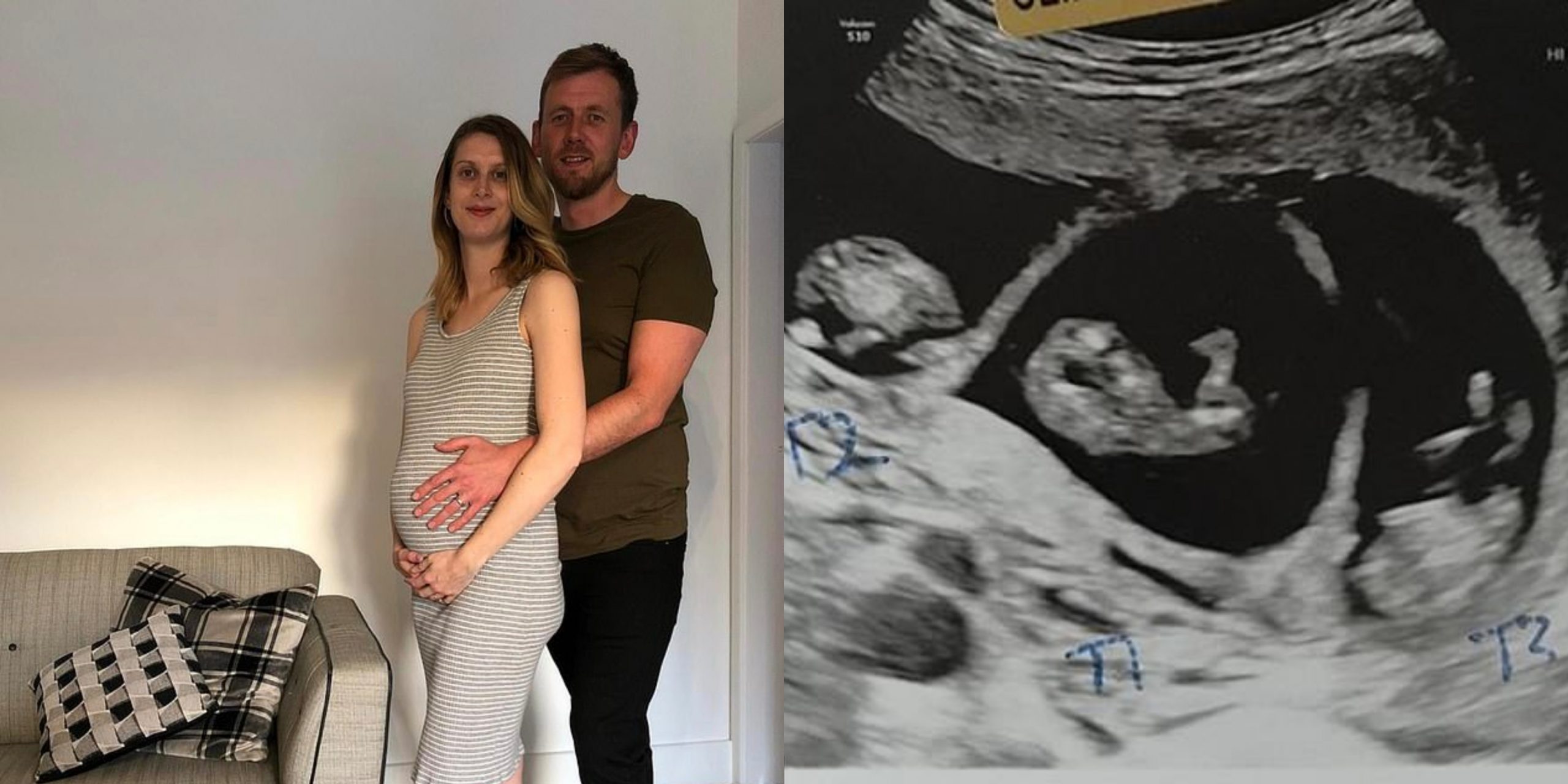 მედდა, რომელიც 10 წელი უშვილობაზე მკურნალობდა, სამ ტყუპს ელოდება