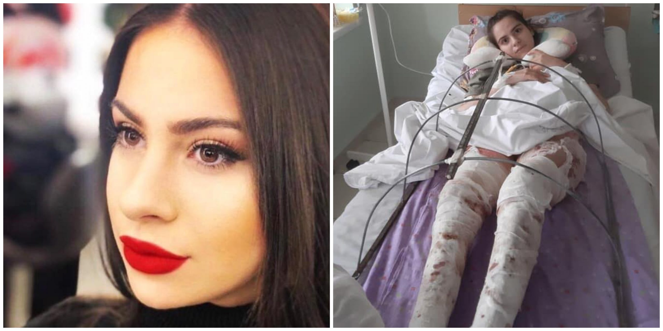 გოგონას, რომლის დაწვაც ყოფილმა შეყვარებულმა ბენზინით სცადა, თანხას უგროვებენ