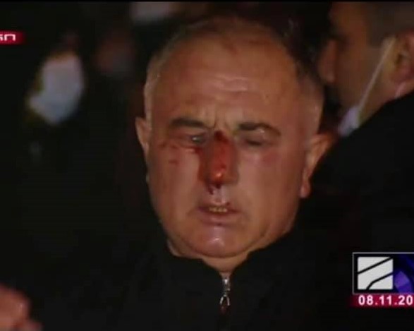 ვინ არის ცესკოთან, აქციაზე დაშავებული მომიტინგე, რომელმაც თვალის ტრავმა მიიღო