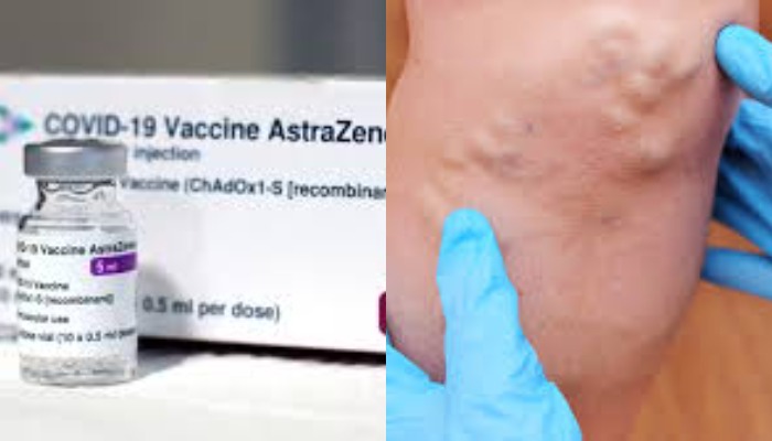 AstraZeneca-ს ვაქცინით გამოწვეული თრომბის მიზეზები აღმოაჩინეს – უცხოური მედია